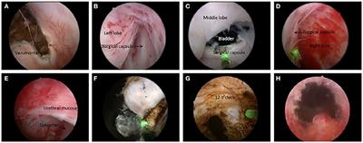 A Modified Technique of Thulium Laser Enucleation for Benign Prostatic Hyperplasia With Non-morcellator Approach